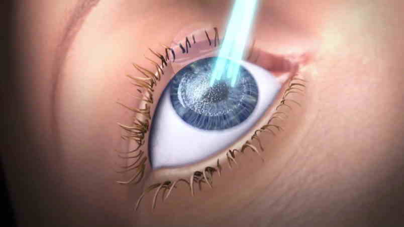 How Your Age Can Influence Your Laser Eye Surgery Options
